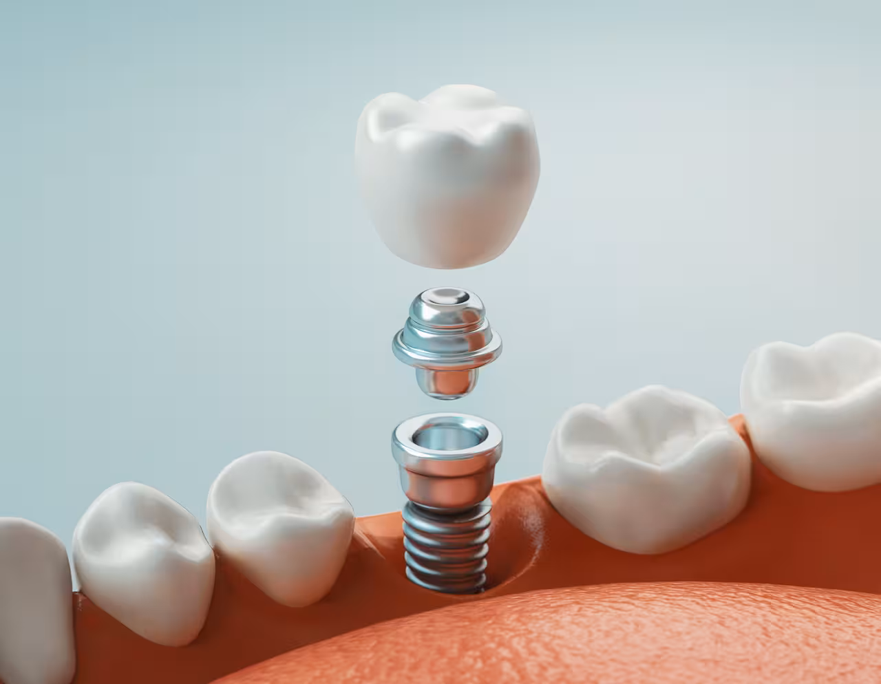 Are Dental Crowns As Strong As Real Teeth?