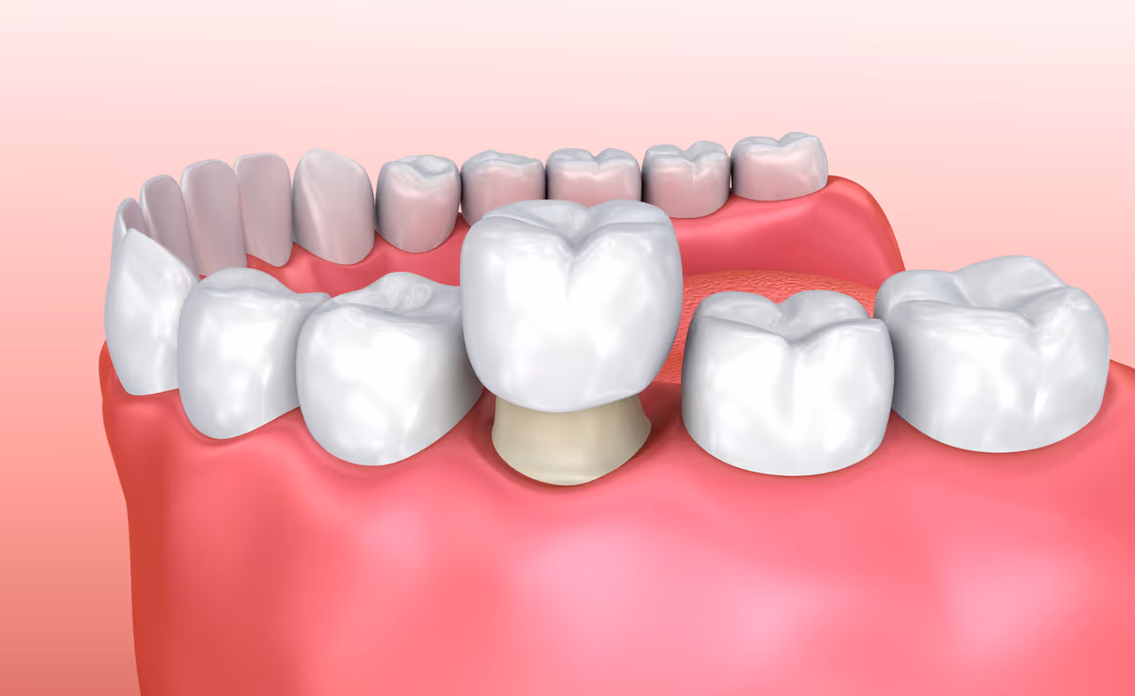 What to Know About Dental Crowns for Restoring Damaged Smiles?